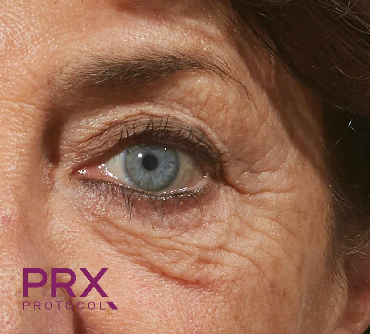 PRX T33 Eye Treatment Before | Facial Art Institute